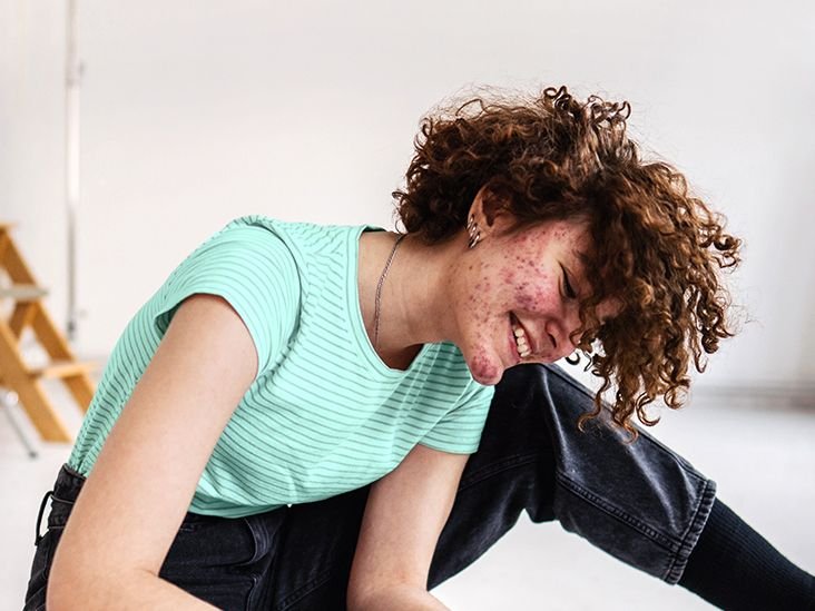 GRt-female-with-acne-smiling-732x549-thumb.jpg